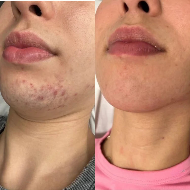 PAINLESS BODY HAIR REMOVAL CREAM