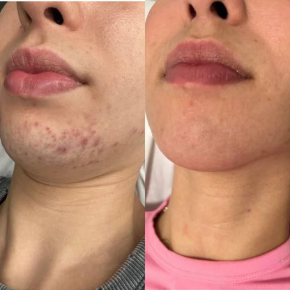 PAINLESS BODY HAIR REMOVAL CREAM